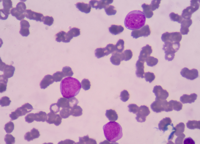Worse Survival in AML for Black Patients